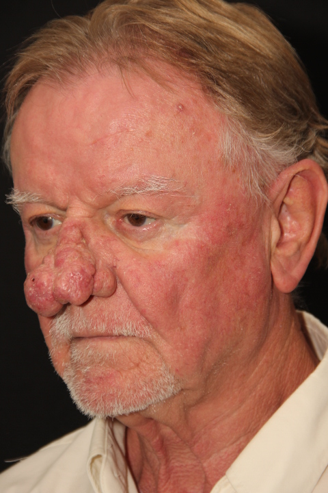 Male patient before Rhinophyma
