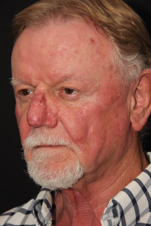 Male patient after Rhinophyma