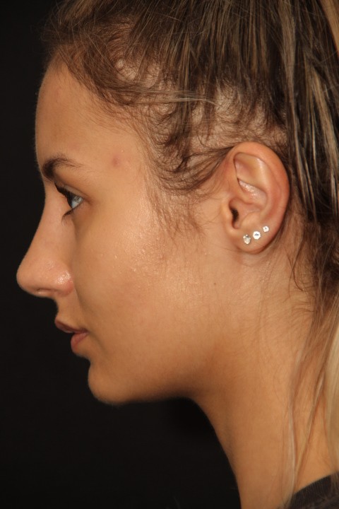 Female patient after primary rhinoplasty