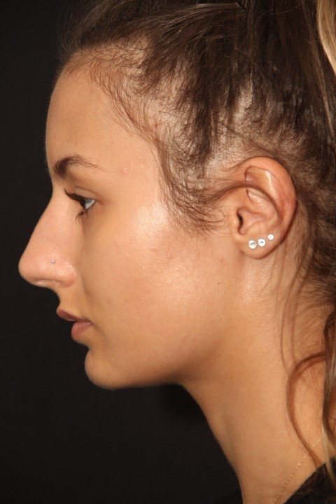 Female patient before primary rhinoplasty