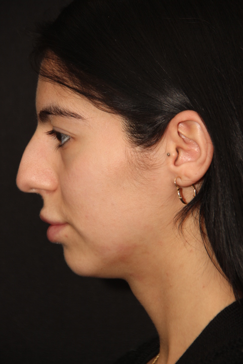 Female patient before primary rhinoplasty