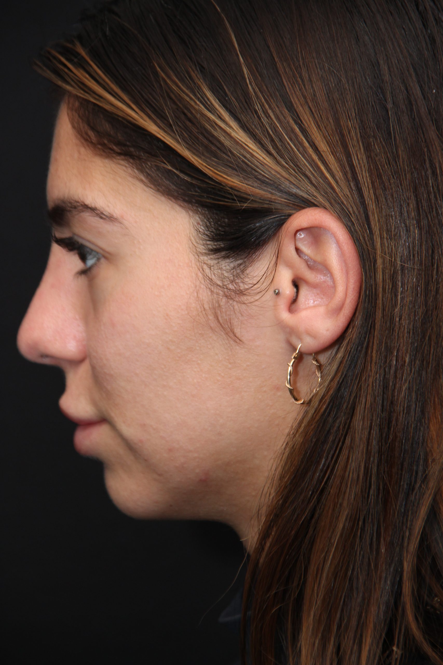 Female patient after primary rhinoplasty
