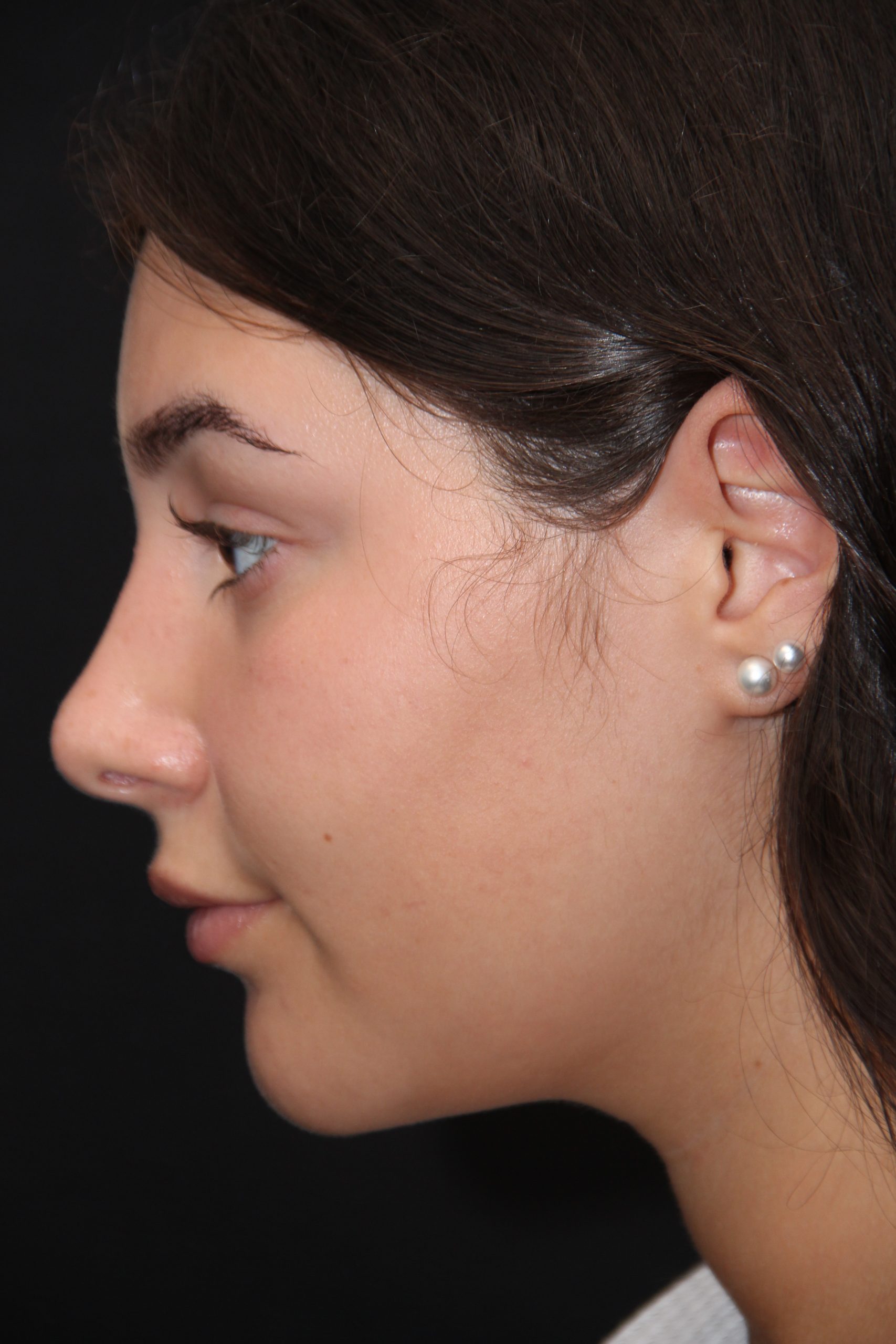 Female patient after primary rhinoplasty