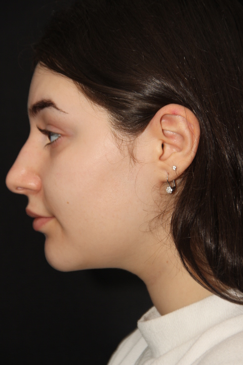 Female patient before primary rhinoplasty