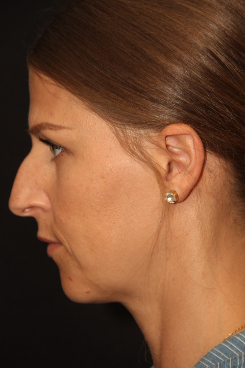 Female patient before primary rhinoplasty