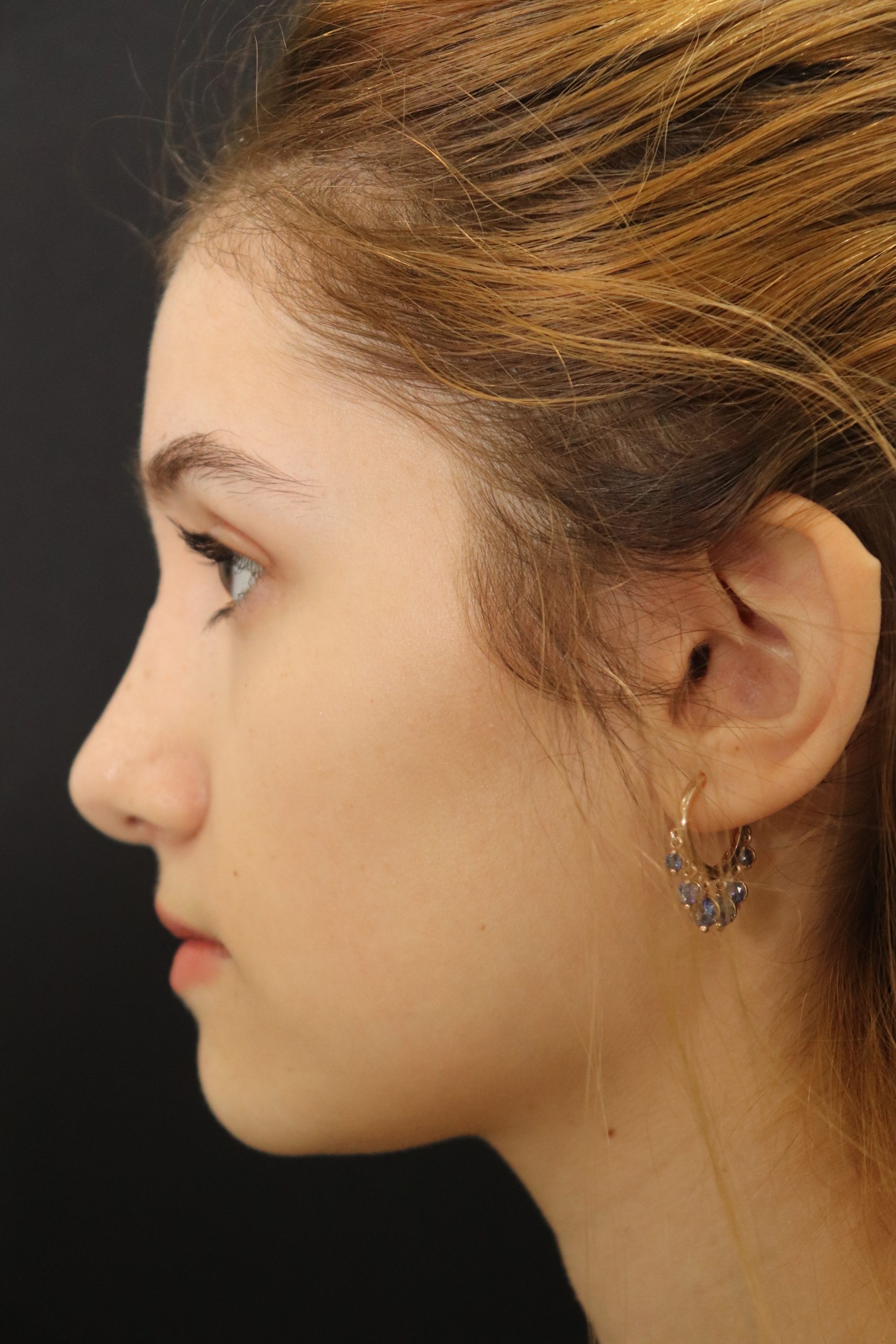 Female patient after primary rhinoplasty