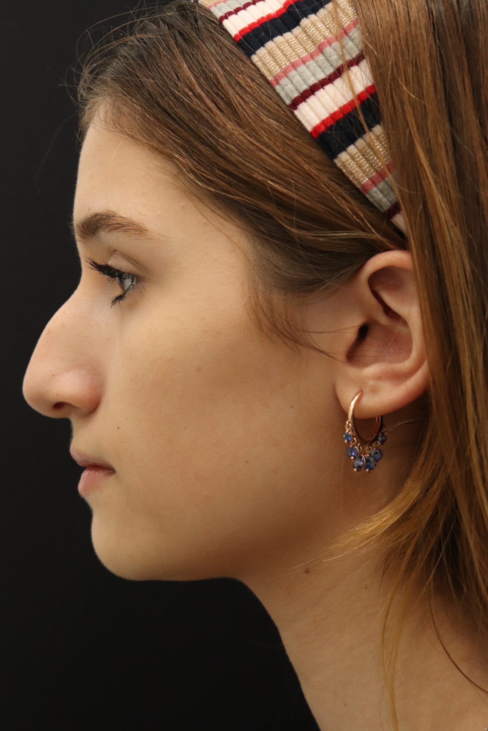 Female patient before primary rhinoplasty