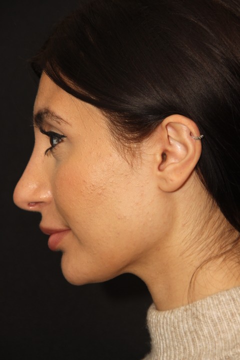Female patient after primary rhinoplasty