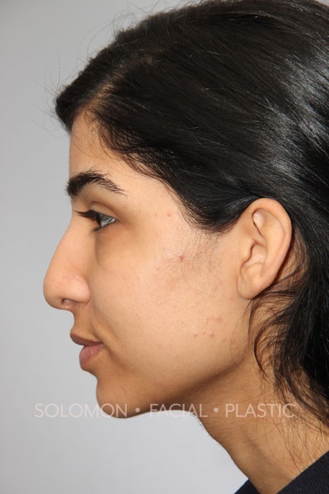 Female patient before primary rhinoplasty
