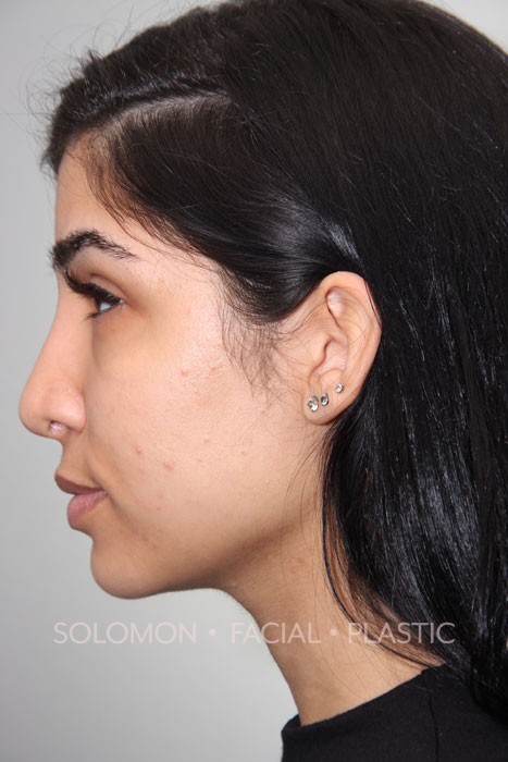 Female patient after primary rhinoplasty