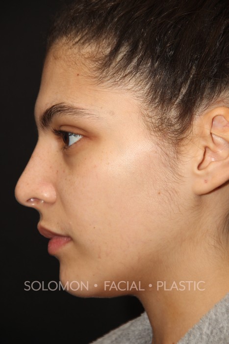 Female patient after primary rhinoplasty