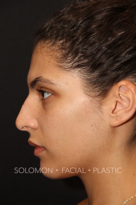Female patient before primary rhinoplasty