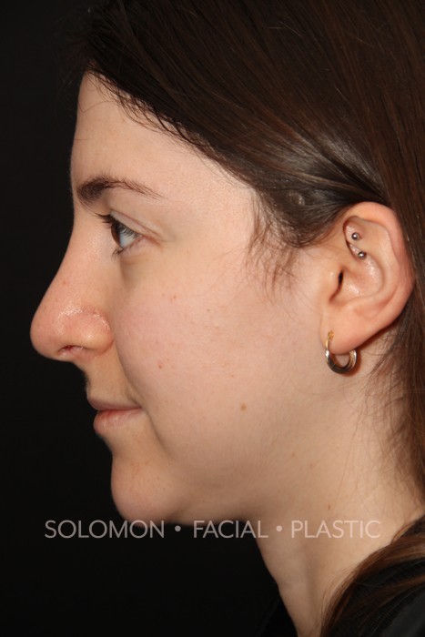 Female patient after primary rhinoplasty