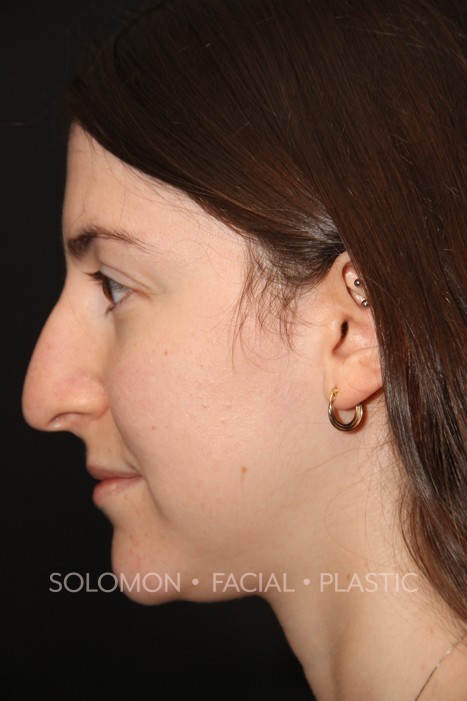 Female patient before primary rhinoplasty