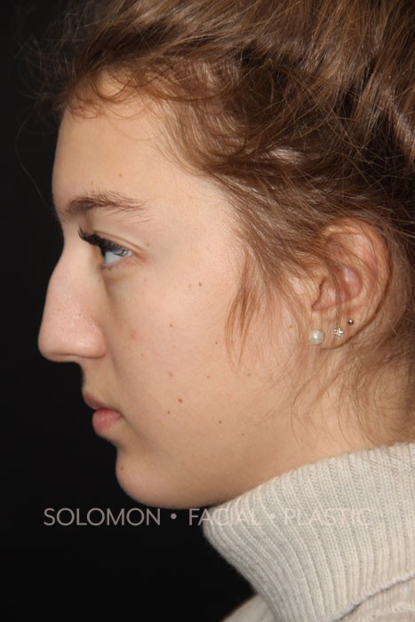 Female patient before primary rhinoplasty