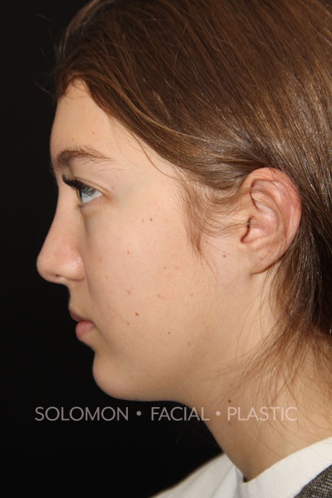 Female patient after primary rhinoplasty