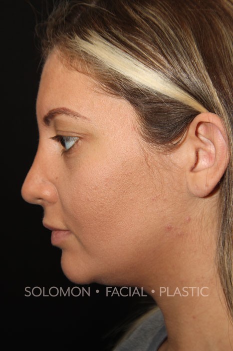 Female patient after primary rhinoplasty