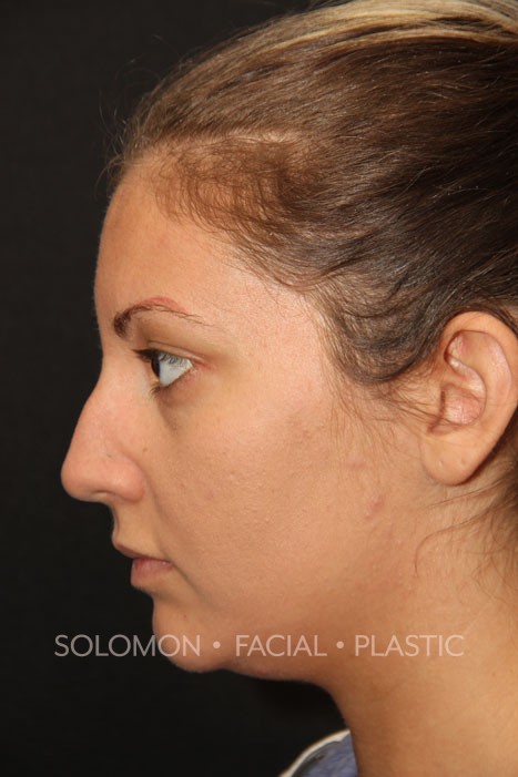Female patient before primary rhinoplasty