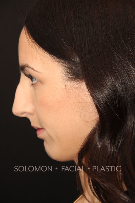 Female patient before primary rhinoplasty