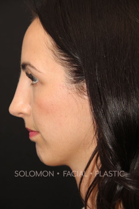 Female patient after primary rhinoplasty