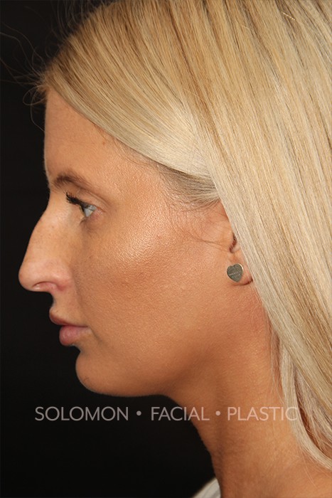 Female patient before primary rhinoplasty