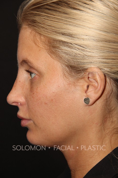 Female patient after primary rhinoplasty
