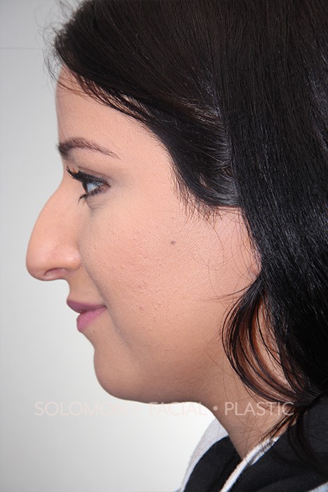 Female patient before primary rhinoplasty