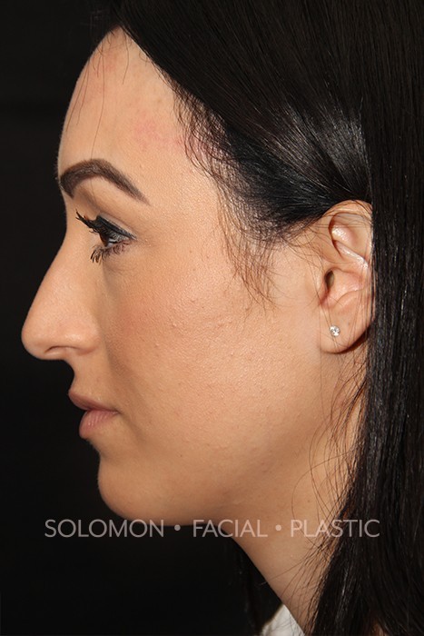 Female patient before primary rhinoplasty