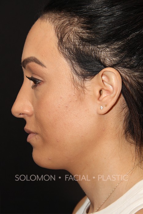 Female patient after primary rhinoplasty