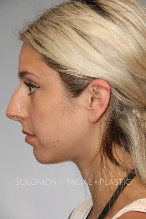 Female patient before primary rhinoplasty