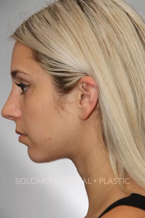 Female patient after primary rhinoplasty
