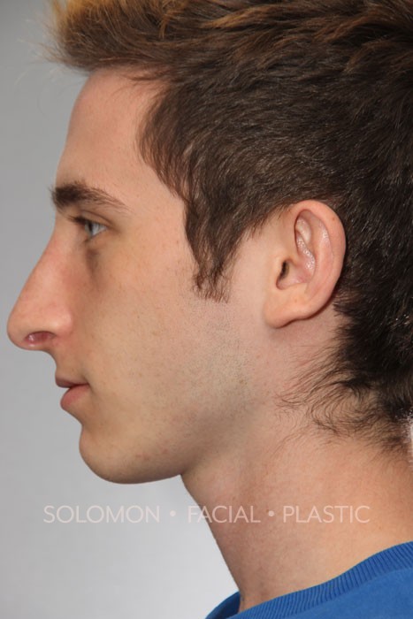 Male patient after primary rhinoplasty