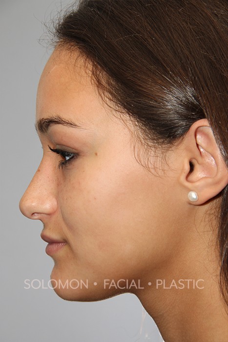 Female patient after primary rhinoplasty