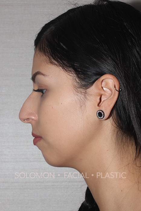 Female patient before primary rhinoplasty