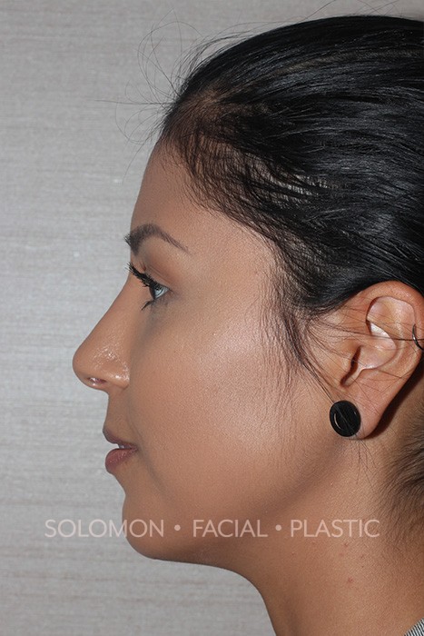Female patient after primary rhinoplasty