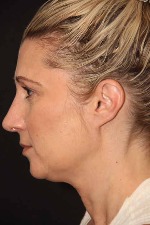 Female patient after primary rhinoplasty