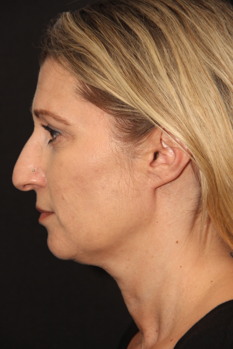 Female patient before primary rhinoplasty