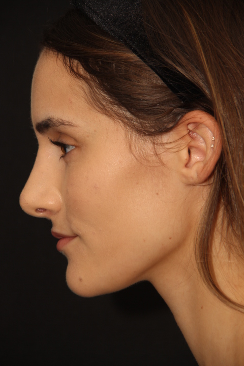 Female patient after primary rhinoplasty