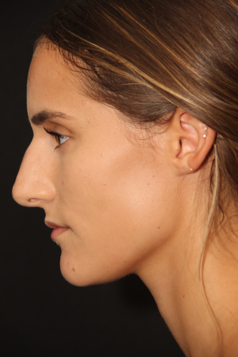 Female patient before primary rhinoplasty