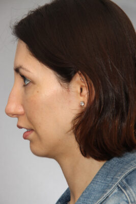 Female patient before primary rhinoplasty