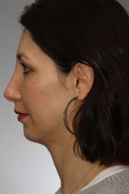 Female patient after primary rhinoplasty