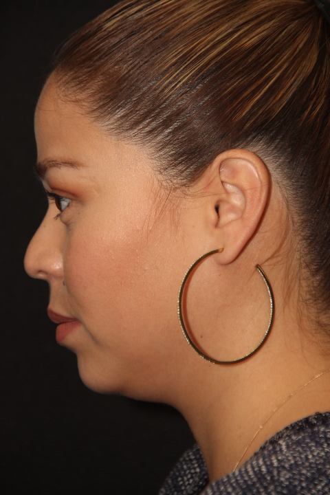 Female patient before primary rhinoplasty