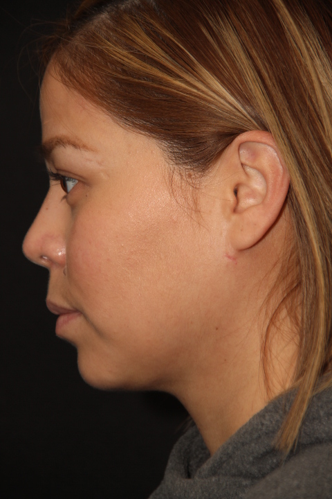 Female patient after primary rhinoplasty