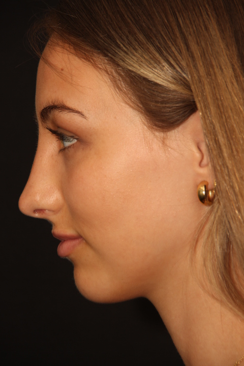 Female patient after primary rhinoplasty