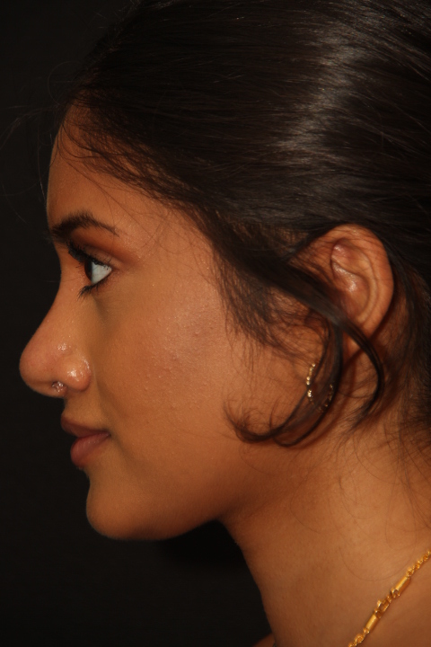 Female patient after primary rhinoplasty