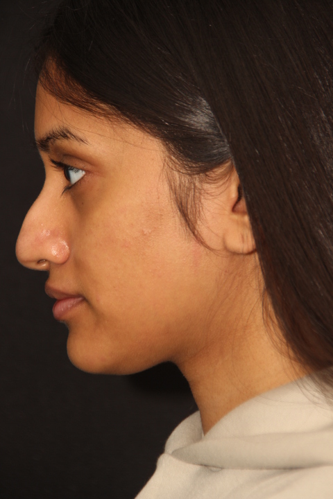 Female patient before primary rhinoplasty