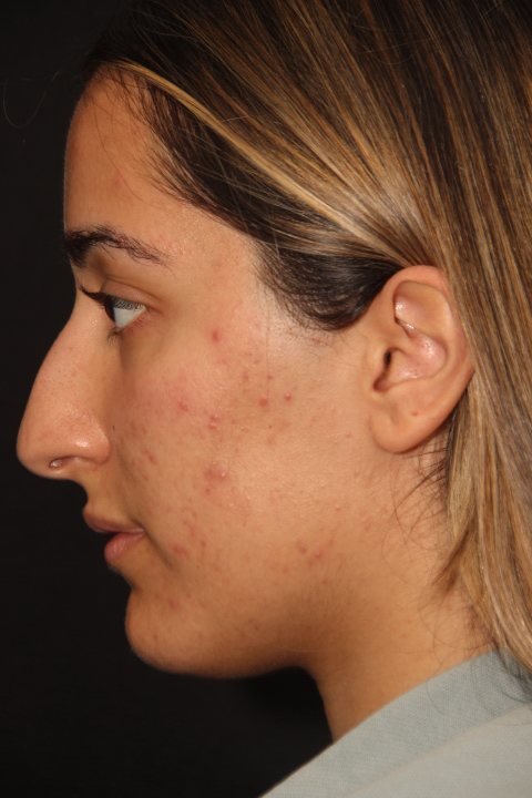 Female patient before primary rhinoplasty