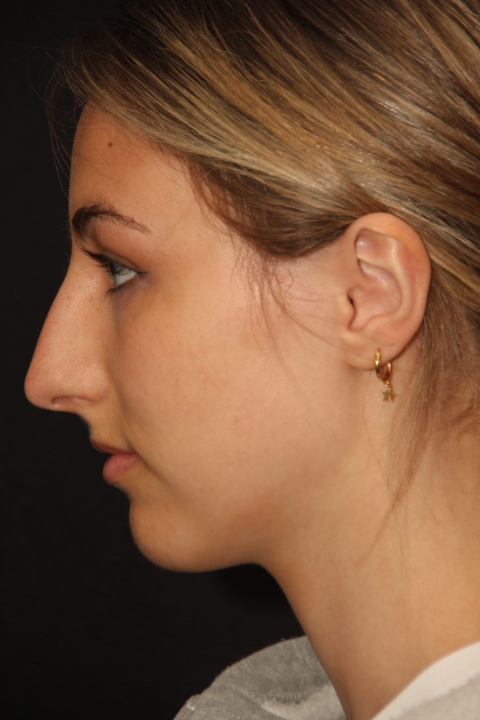 Female patient before primary rhinoplasty