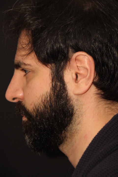 Male patient before primary rhinoplasty