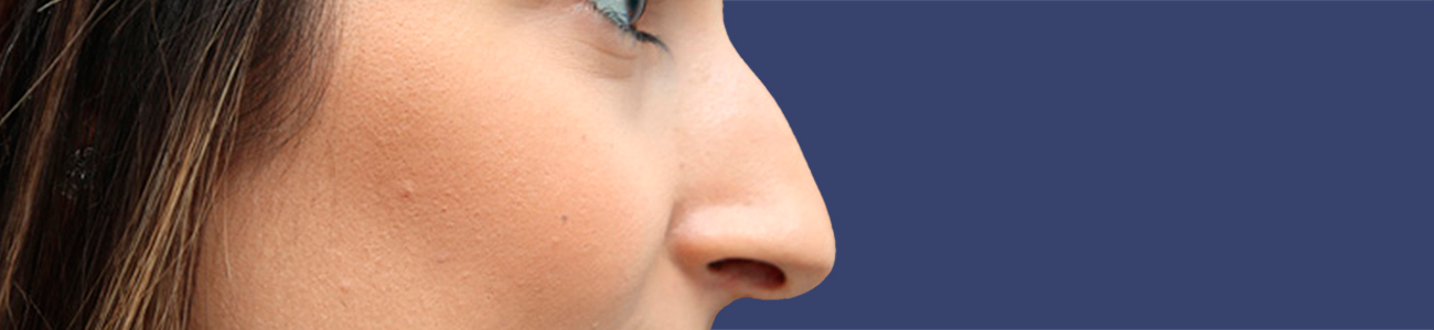 Before rhinoplasty surgery